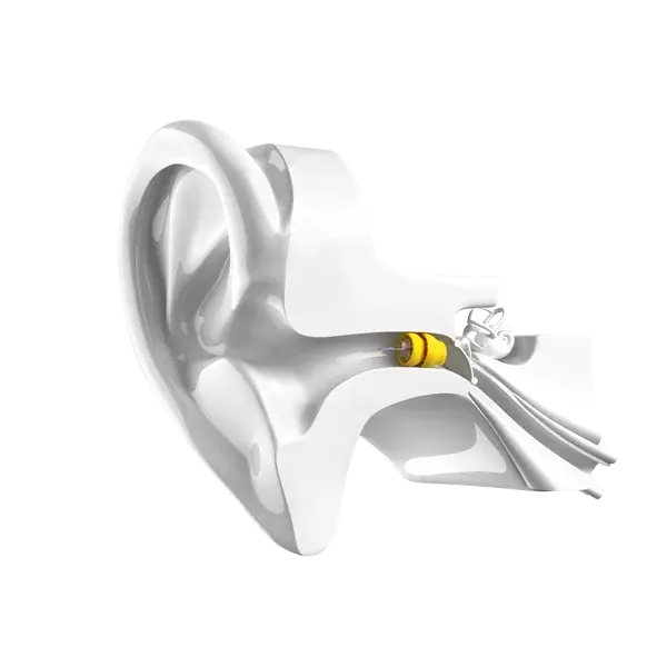 Anatomical ear illustration — Lyric placement 4mm from tympanic membrane